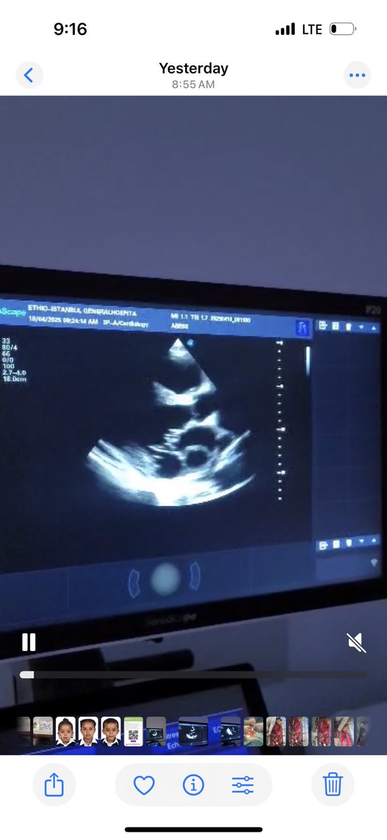 agwar_fekede's tweet photo. In a six hours long heart surgery local cardiac team of Ethiopia successfully performed the first Sub-Mitral aneurysm repair along with Mitral valve replacement for a 31 years old patient. https://t.co/7PkjMjTwnW