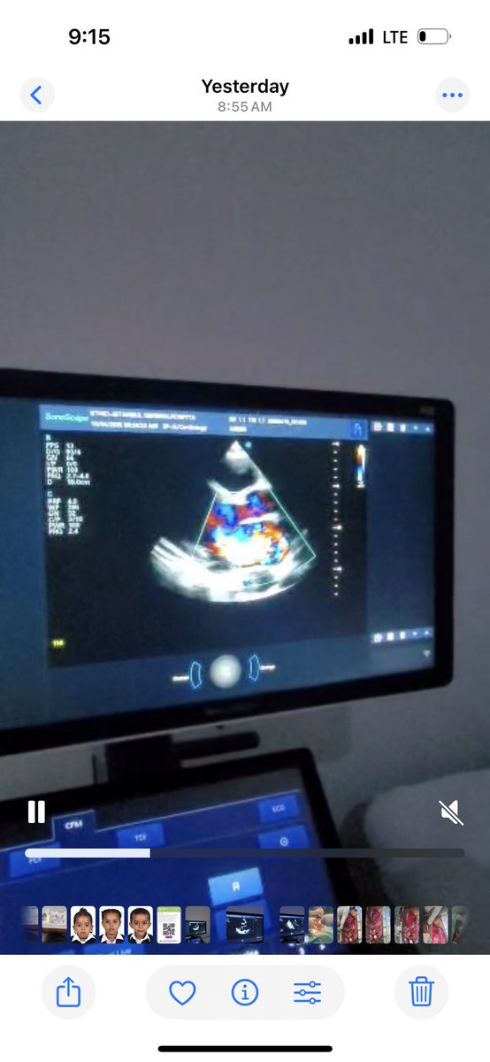 agwar_fekede's tweet photo. In a six hours long heart surgery local cardiac team of Ethiopia successfully performed the first Sub-Mitral aneurysm repair along with Mitral valve replacement for a 31 years old patient. https://t.co/7PkjMjTwnW