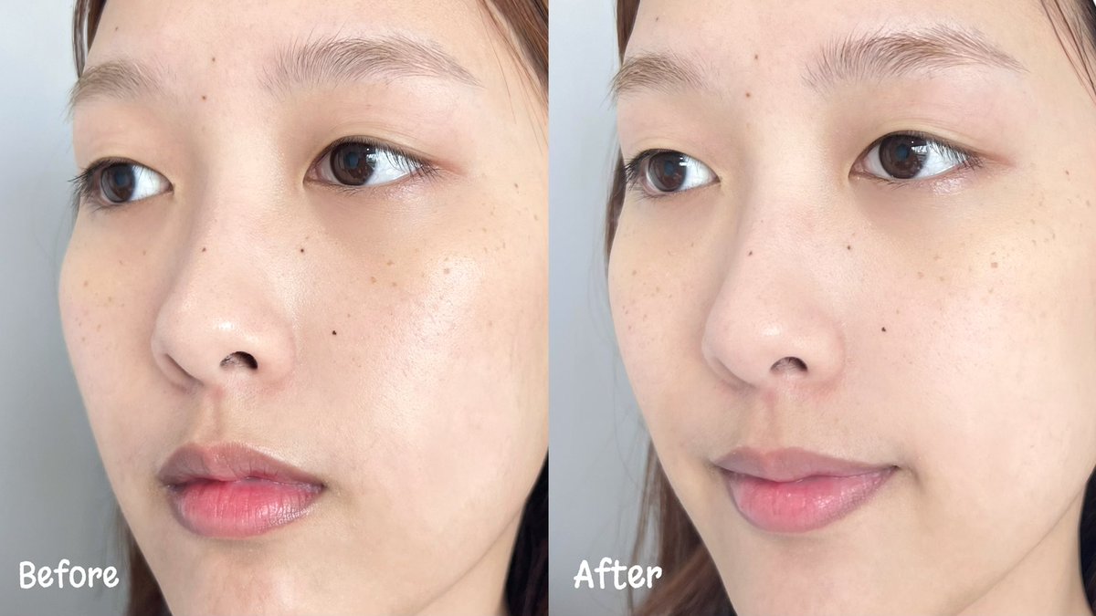 เห็นคุณแม้กณฐใช้แล้วน่าลองมาก นี่เลยไปตำมาละ น้องโฟมลดสิวคุมมัน Mentholatum Acnes Deep Wash เค้าเป็นเเบรนด์โฟมเวชสำอาง นี่ชอบตรงที่เนื้อโฟมนุ่มละเอียดมาก ใช้แล้วนุ่มสบายผิว หลังล้างคือผิวสะอาด ไม่แห้งตึง ความมันน้อยลง พวกรอยสิวก็จางลงด้วย แถมไม่ทำให้เกิดสิวเพิ่มอีก ชอบมาก ราคาไม่แรง 💚 #ใช้ดีบอกต่อ #โฟมล้างหน้าคุมมัน #โฟมลดสิวผิวมัน