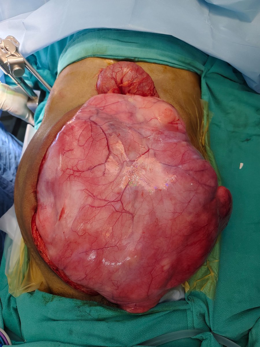 dr.basant (@drbasant1) on Twitter photo performed an en bloc excision of a 13×15 cm giant retroperitoneal liposarcoma with right hemicolectomy involving ureter & external iliac artery. Reconstruction with boari flap and saphaenous vein graft
. # GI Oncosurgery # Surgery X
👇 performed an en bloc excision of a 13×15 cm giant retroperitoneal liposarcoma with right hemicolectomy involving ureter & external iliac artery. Reconstruction with boari flap and saphaenous vein graft
. # GI Oncosurgery # Surgery X
👇