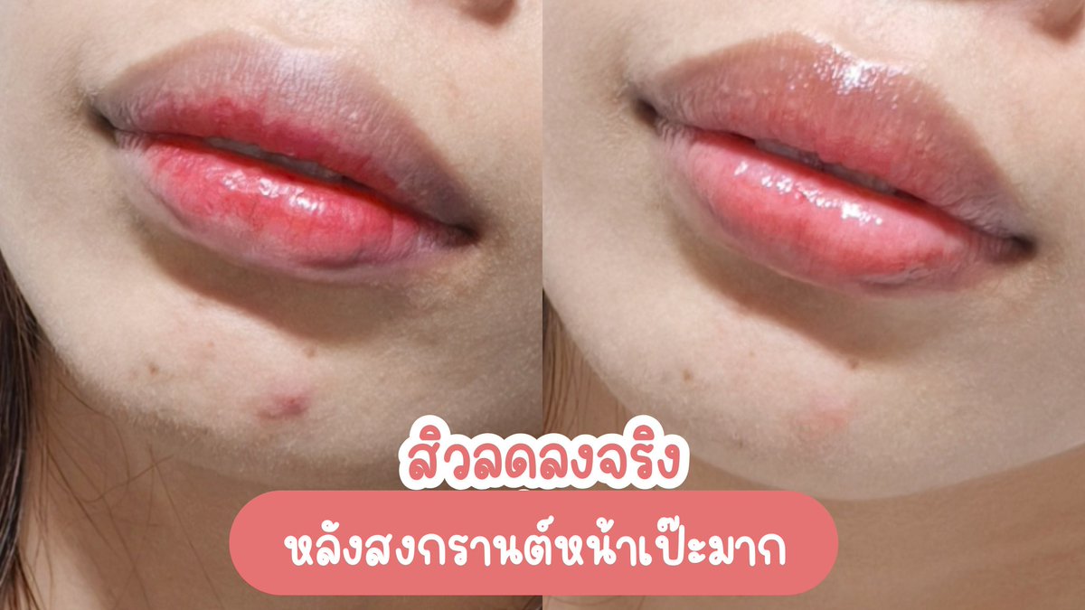 มีไอเทมลับสำหรับคนเป็นสิวมาฝาก  Jelly Me ZinC อร่อยมากกก กลิ่นพีชหอมๆ กินละสิวลดลงจริง หลังสงกรานต์นี้โดนสาดมาหนักแค่ไหน ก็ไม่หวั่นสิวขึ้นละค้าาาาาา ซองละ 20 บาทเองไปตำๆ พิกัด7-11

#JellyMe #JellyMeCuti #ความคิวทิบิลด์ง่ายได้ทุกวัน #JellyMeZinc #ลดสิว #HowtoPerfect https://t.co/J0NogFv0Go