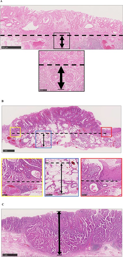 #EditorsChoice  #OpenAccess  What is the impact of vertical depth of tumour on lymph node metastases among patients with T1b esophageal cancer? Is there a threshold depth that predicts the presence of nodal disease?
academic.oup.com/dote/article/3…