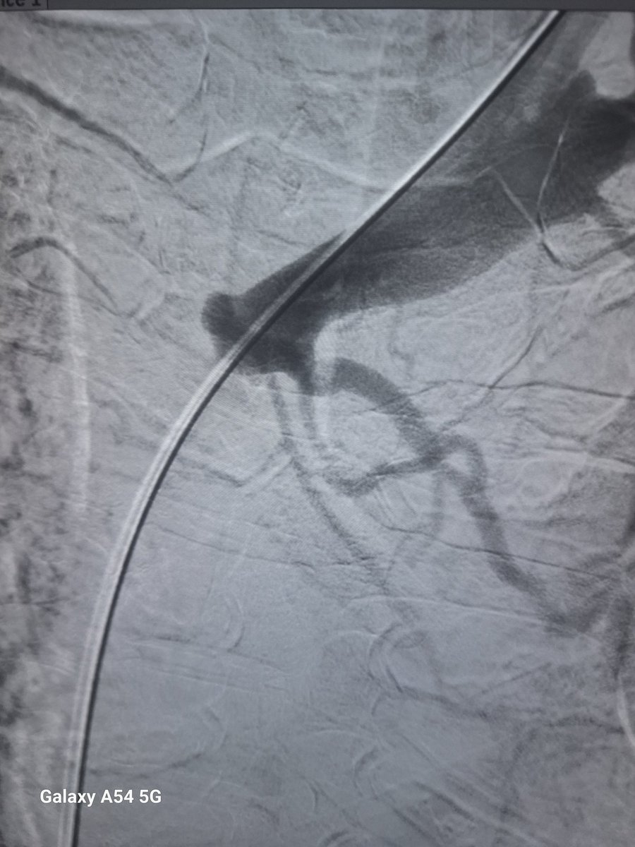 vascularsrgn's tweet image. In the quest for early transplant, don’t forget the lifeline — vascular access. This patient was a week away from transplant, with only a catheter in place which was removed without a plan . Access planning is equally important 
#AccessEd @VascularForum
#MedTwitter #Nephrology