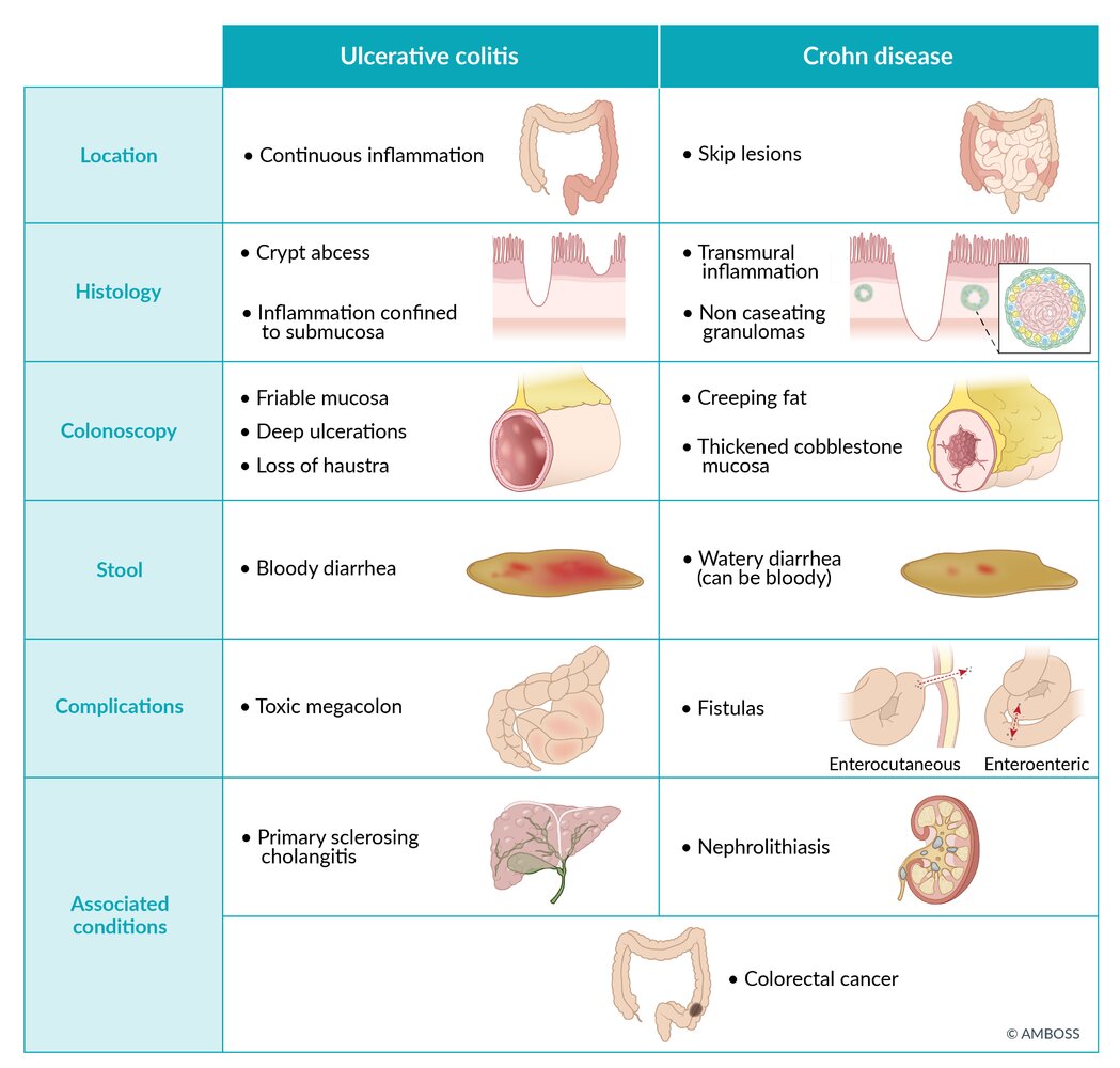 Differences between ulcerative colitis and Crohn’s disease - what is this missing?