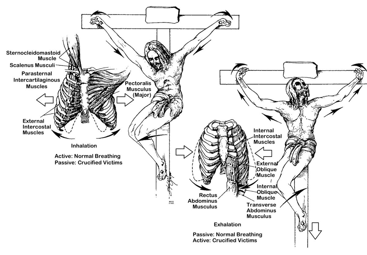 medicosergio's tweet image. Sobre la muerte de Jesucristo 
___________
(JAMA 1986; 255:1455-1463)

Jesús de Nazaret fue sometido a juicios judíos y romanos, azotado y condenado a muerte por crucifixión. La flagelación le produjo profundas laceraciones similares a estrías y una considerable pérdida de…