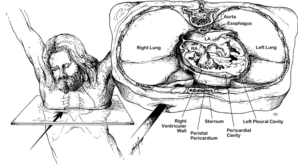 medicosergio's tweet image. Sobre la muerte de Jesucristo 
___________
(JAMA 1986; 255:1455-1463)

Jesús de Nazaret fue sometido a juicios judíos y romanos, azotado y condenado a muerte por crucifixión. La flagelación le produjo profundas laceraciones similares a estrías y una considerable pérdida de…