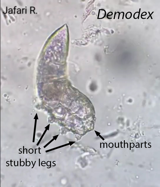 #Parasite Case 774 answer is up: Demodex sp. Look at all of the legs! I’ve compiled the whole list of Demodex blog cases here: parasitewonders.blogspot.com/2025/04/answer… a great educational resource. Thanks again to Dr. Rasool Jarafi for the great case.  #mayopath #pathology #PathBugs