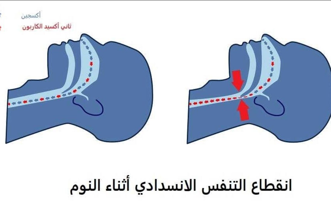 YazanSnQ's tweet photo. ماهو انقطاع التنفس الانسدادي أثناء النوم؟
#انقطاع_التنفس_اثناء_النوم https://t.co/wZCzLQk4CK
