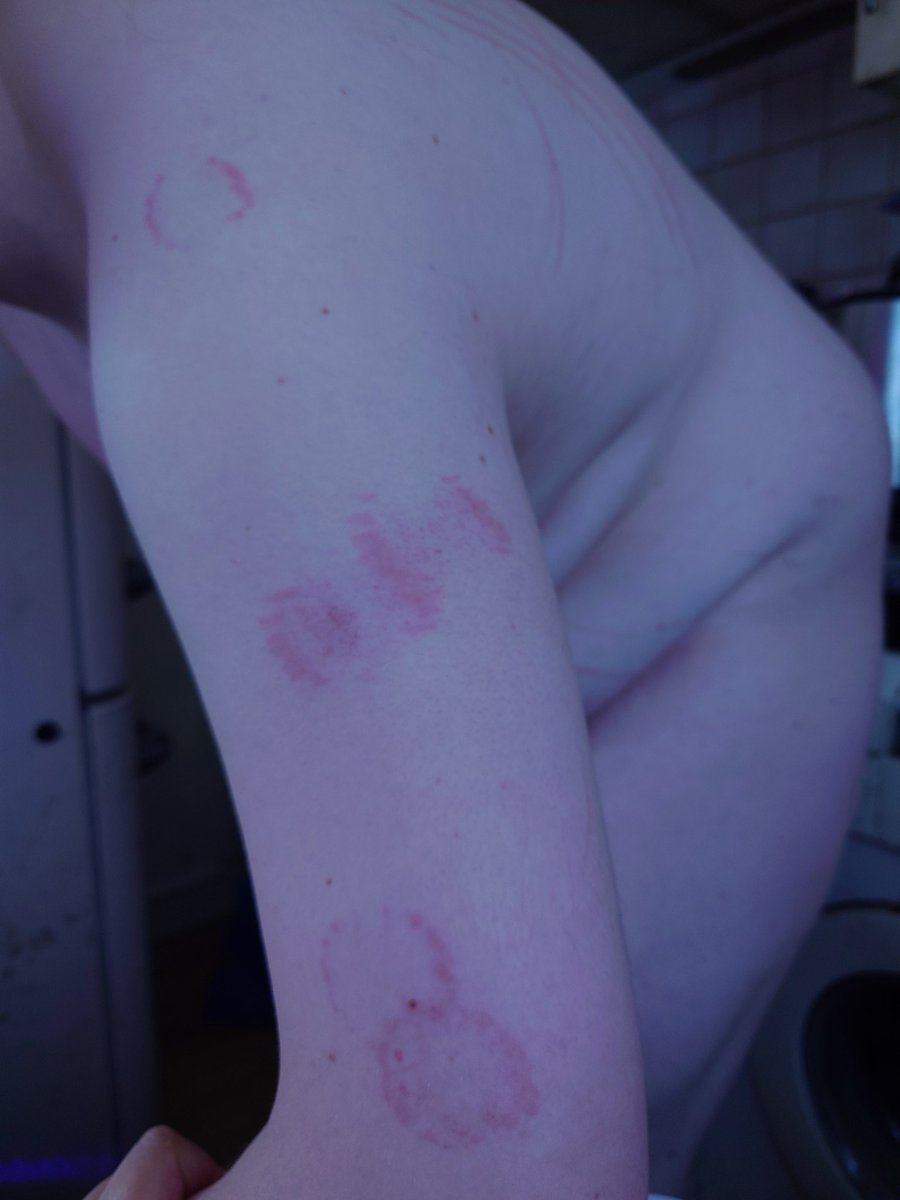 Better picture of the bites :3