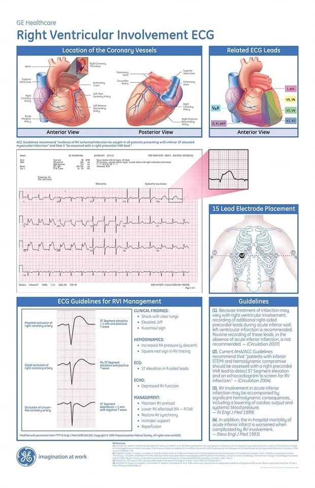 ZHeart11768530's tweet photo. 🔴Right Ventricular Involvement ECG signs in Myocardial Infarction
🔸Pdf
https://t.co/CVgMdYUJW6
#cardiology #cardiology #knowledgeofecg #cardiologia #electrocardiogram #ecginterpretation #hearts #nursing #ecg #electrocardiograma #electrocardiogram #cardiovascular #nurse https://t.co/vt39hdA7um