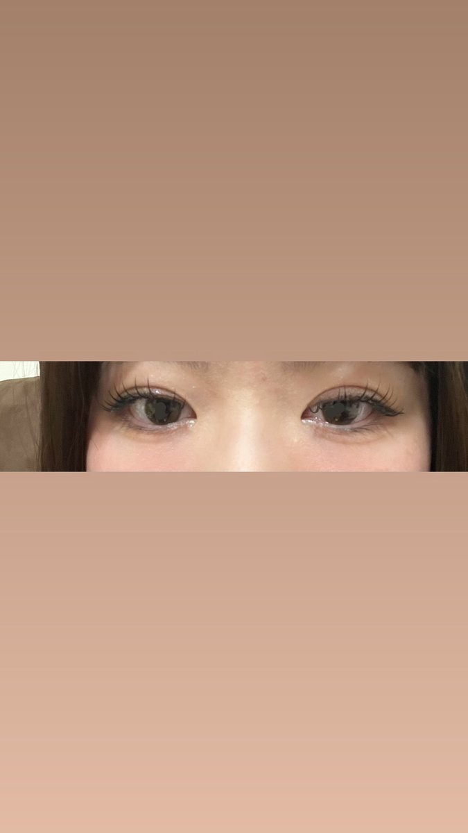 m9_oh's tweet photo. 埋没5日目
左右差が気になります🥲
右が幅広く被さってる感じです。
現時点でかなり左右差があるように見えるのですが、1ヶ月後や3ヶ月後になれば気にならない程度になるでしょうか。
再施術したほうが良いでしょうか。
埋没経験者や有識者の方のコメントお待ちしております🙇‍♂️
#埋没#ダウンタイム https://t.co/r5v6HbUdem