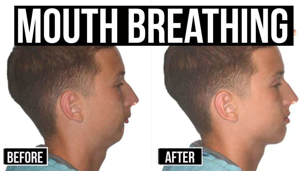 FitFastCoach's tweet photo. PROBLEM 2: Mouth Breathing

If you snore or breathe through your mouth at night...

Your brain gets starved of oxygen, which sabotages deep sleep and leaves you foggy in the morning.

Mouth closed = calm, oxygen-rich sleep.
Mouth open = stress, inflammation, exhaustion. https://t.co/hTgNsduvpM