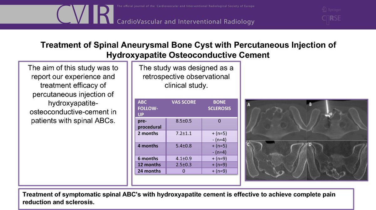#tb to 2023! 🔙
Treatment of Spinal Aneurysmal Bone Cyst with Percutaneous Injection of Hydroxyapatite Osteoconductive Cement
link.springer.com/article/10.100…