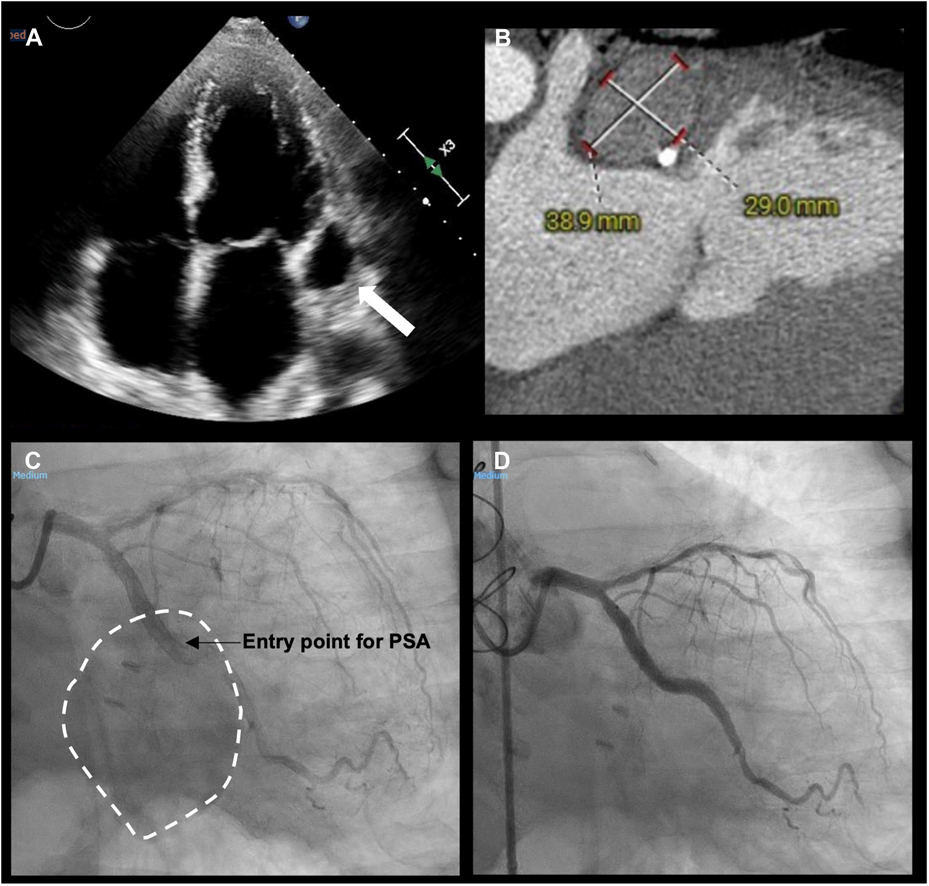 JACC Journals (@jaccjournals) on Twitter photo 77y/o man presented to the ED with angina that had started 24 hours prior. His #ECG was unremarkable, and laboratory tests showed a mild elevation in cardiac troponin I (3.72 ng/mL). What's the diagnosis? 🤔
🔗 jacc.org/doi/10.1016/j.… #JACCCaseReports #PCI <a href="/azeemlatib/">Azeem Latib</a> 77y/o man presented to the ED with angina that had started 24 hours prior. His #ECG was unremarkable, and laboratory tests showed a mild elevation in cardiac troponin I (3.72 ng/mL). What's the diagnosis? 🤔
🔗 jacc.org/doi/10.1016/j.… #JACCCaseReports #PCI <a href="/azeemlatib/">Azeem Latib</a>