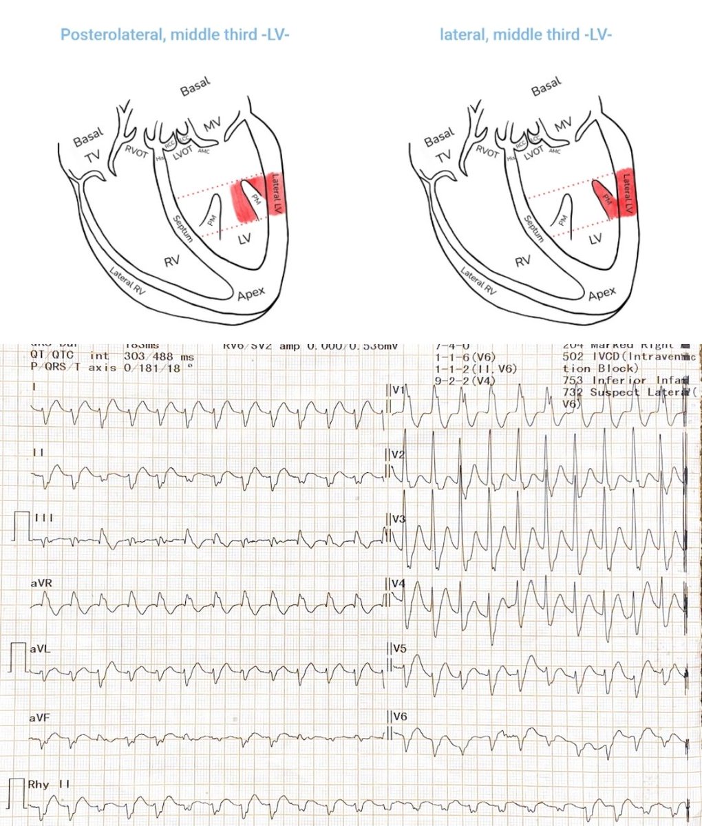 Milan Koštek (@kostekmilan) on Twitter photo EASY-ECG app helps with defining the origin of VT as well. Here with two results depending on how you define the polarity in the lead III. ECG from <a href="/DrRajeshG1/">Dr G Rajesh (Gopalan Nair Rajesh).</a> with the link in the thread. EASY-ECG app helps with defining the origin of VT as well. Here with two results depending on how you define the polarity in the lead III. ECG from <a href="/DrRajeshG1/">Dr G Rajesh (Gopalan Nair Rajesh).</a> with the link in the thread.