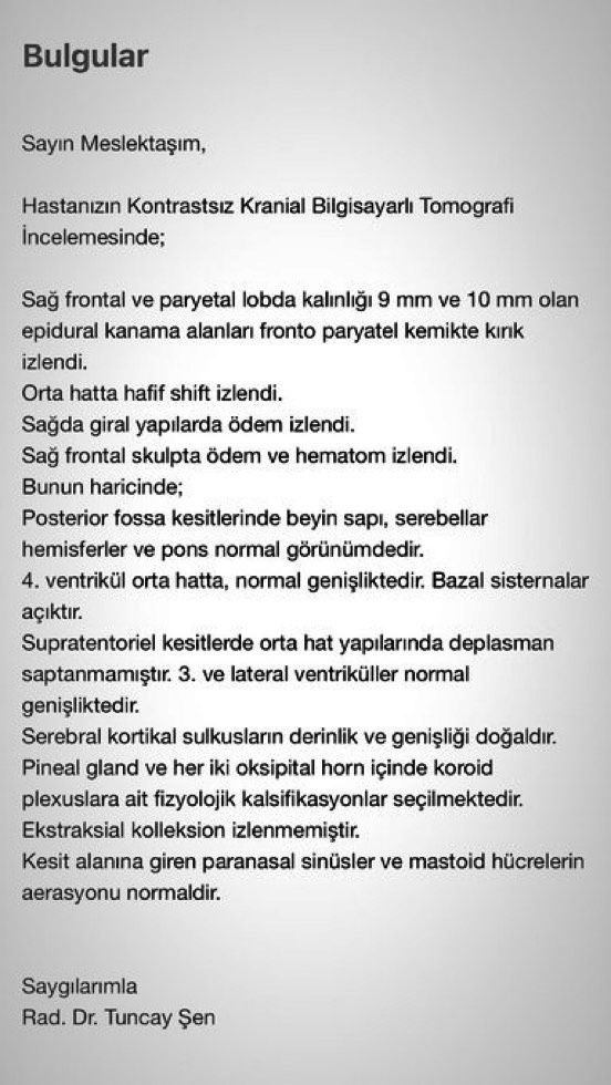 brctv12's tweet photo. 3.5 Yaşındaki Kız Çocuğuna, Suadiye Anabilim Koleji’nde Dehşeti Yaşattılar‼️

Arkadaşları tarafından kaydırağın tepesinden itilerek kafa üstü yere düşen 3.5 yaşındaki kız çocuğunu, okul yönetimi ambulansa haber vermek bir yana, sınıfa indirip etkinlik yaptırmaya çalıştı. “Endişelenecek bir durum yok, okulda kalabilir” diyerek annesini ikna etmeye çalıştılar.

Kızın kafasındaki kanı ıslak mendille silmeleri, durumu ne kadar ciddiye aldıklarını açıkça gösteriyordu. Okulun bahçesindeki zemin beton, üstü ise göstermelik çimle kaplanmış. Yüzlerce çocuğun oynadığı parkta güvenlik önlemleri yoktu. Olay sırasında öğretmeni, bahçe saatinde 3 yaşındaki 11 çocukla tek başına bıraktı; alana kamera bile koymadığı gibi, okulda revir, doktor ve hemşire olmadığı da ortaya çıktı.

Anaokulu koordinatörü Didem Aygün, kızım yaşam mücadelesi verirken ameliyathane kapısının önünde kaydırağın boyunda sıkıntı olmadığını ispatlamaya çalıştı. Çocuğun değil, kurumun derdine düşen bir yaklaşım sergiledi.

Olay sonrası, kız çocuğunun acil servise götürülmesi gerektiği söylendi. Ancak Kozyatağı Central Hospital'daki yetkililer, “bir şeyi yok” diyerek geri gönderdi. Beyin cerrahı Dr. Ayhan Kara, muayenesinde kızımın beyin tomografisinde kanama ve çatlaklar tespit etti. Ama bu kritik durumda, acil olarak ameliyata alınması gerekirken, “4 saat sonra” başka bir hastaneye yönlendirdiler. Bu süreçte “uyumasında sakınca yoktur” denildi‼️

Kız çocuğu, hem fiziksel hem de psikolojik olarak büyük bir travma yaşıyor. İhmaller yüzünden ölümden dönüyor. Beyin kanaması geçiriyor, kafasında çatlaklar oluşuyor, ameliyat sırasında kafası tamamen kazınıyor ve sayısız tomografi ile radyasyona maruz kalıyor. Günlerce yoğun bakımda kalıp kan kaybediyor.

Ve tüm bunlar yaşanırken, olay sonrası sessizliğe bürünen, okuluna hâlâ kayıt alabilen ve hasta kabulüne devam eden bir insan topluluğu var. Suadiye Anabilim Koleji’nin sahipleri Niyazi Kılıç ve Serkan Kılıç, olaydan sonra hiçbir sorumluluk almadılar.

#SuadiyeAnabilimKoleji #NiyaziKılıç #SerkanKılıç #KozyatağıCentralHospital #AyhanKara #DidemAygün #ÇocukGüvenliği

NOT: Haberi copy paste yapabilir, izin almadan yayabilirsiniz.