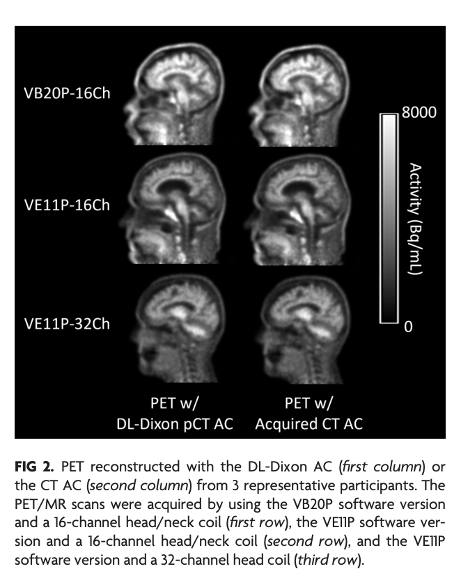 "Accuracy and Longitudinal Consistency of PET/MR Attenuation Correction in Amyloid PET Imaging amid Software and Hardware Upgrades"

doi.org/10.3174/ajnr.A…

<a href="/an_hongyu/">Hongyu An</a>