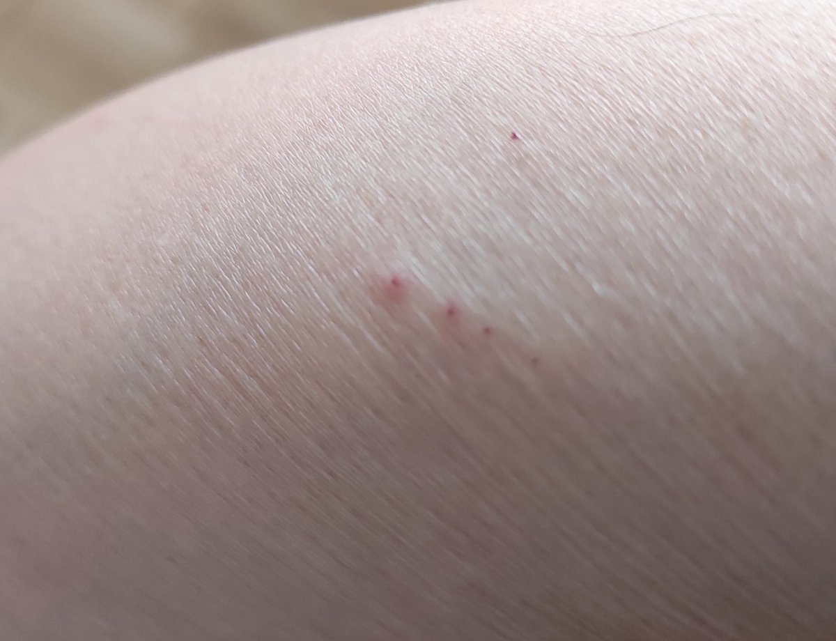 ¿Algún experto en insectos?
Desde ayer me está picando algo en casa y no distingo qué puede ser. Ya llevo varias picaduras como las de la foto. Unas más pequeñas y otras más grandes.
¿Alguien sabe qué puede ser?
¿Quizás una araña, <a href="/Arachno_Cosas/">Soy aracnólogo, pregúntame lo que quieras</a> ? ¿Pulga, chinche?
¡Gracias!