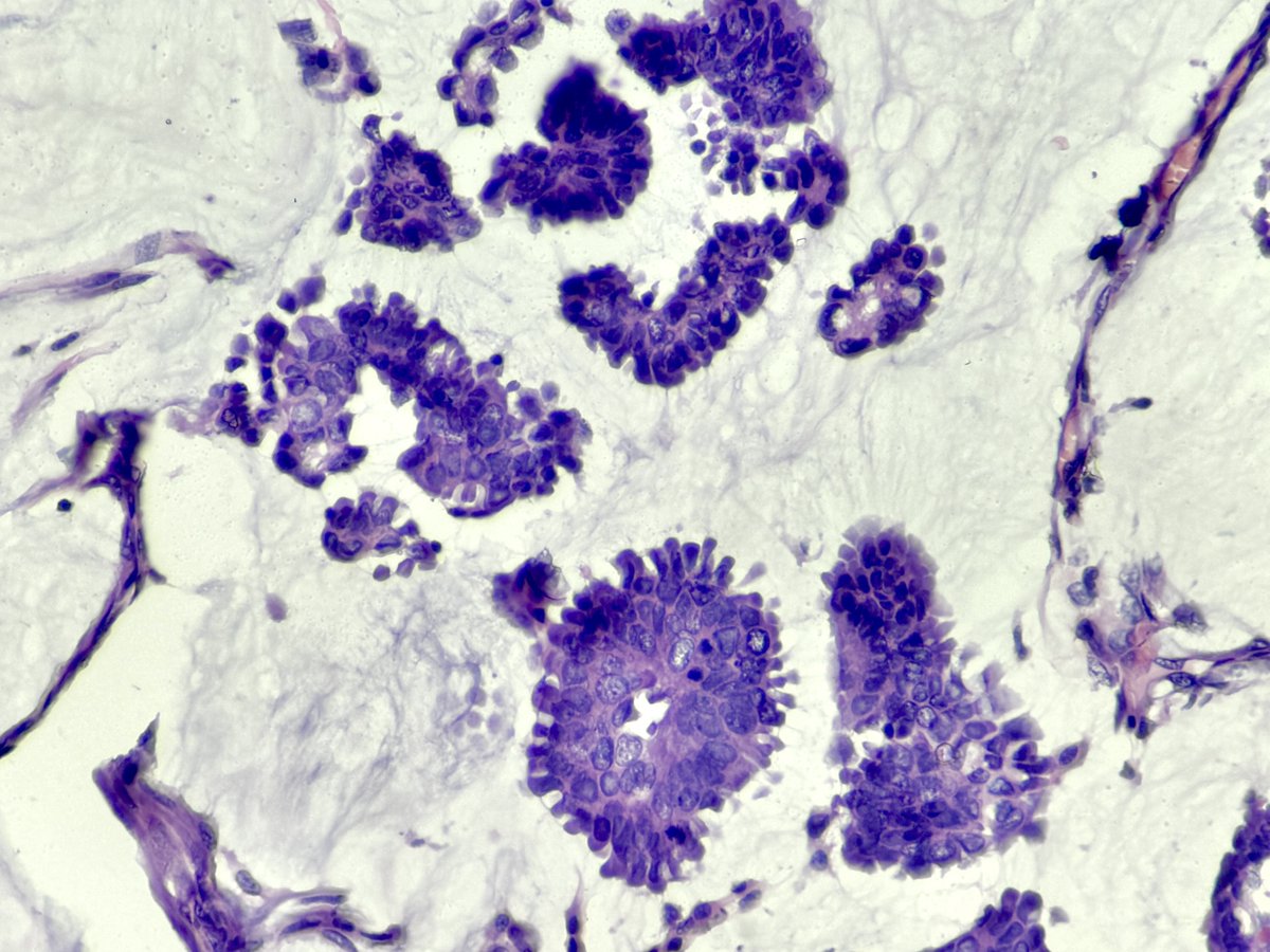Breast Biopsy.......?