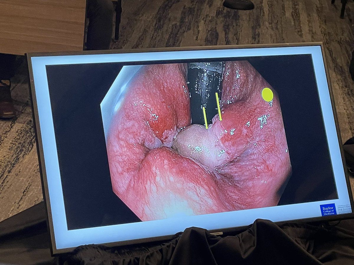 Shifa Umar, MD (@shifaumarmd) on Twitter photo Hemorrhoid Management from the #Guru <a href="/waqmd/">Waqar Qureshi MD</a> #MACG
Highlights:
✔️ Diet & lifestyle
✔️ Office-based procedures
✔️ Advanced endoscopic techniques
#BCM 2️⃣4️⃣th Annual #GIandLiverCourse
<a href="/WasAbiDoc/">Wasif Abidi, MD, PhD</a> <a href="/JDBernicaMD/">Jessica Bernica</a> Hemorrhoid Management from the #Guru <a href="/waqmd/">Waqar Qureshi MD</a> #MACG
Highlights:
✔️ Diet & lifestyle
✔️ Office-based procedures
✔️ Advanced endoscopic techniques
#BCM 2️⃣4️⃣th Annual #GIandLiverCourse
<a href="/WasAbiDoc/">Wasif Abidi, MD, PhD</a> <a href="/JDBernicaMD/">Jessica Bernica</a>