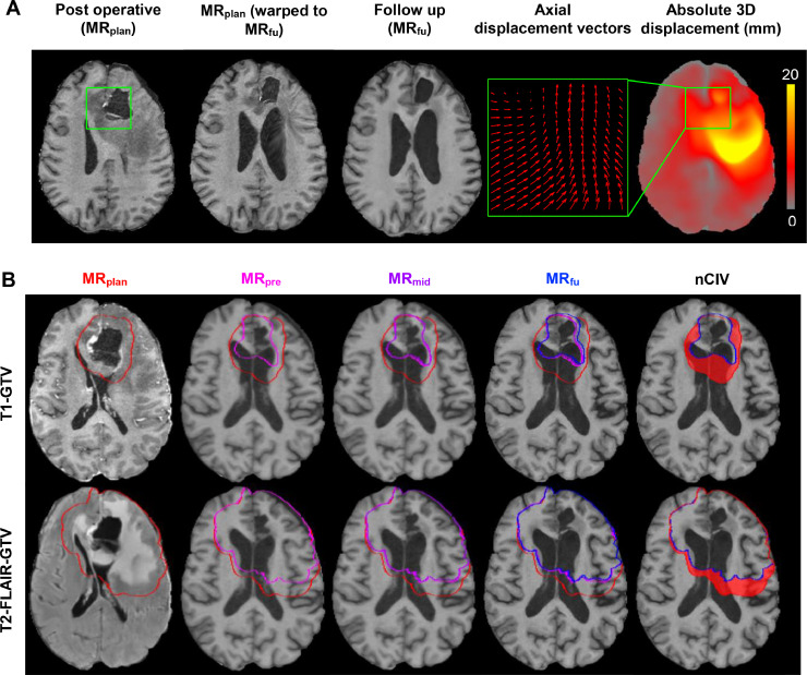 Connor Kinslow, MD (@radoncconnor) on Twitter photo "Timing of planning MRI and patient selection for adaptive radiotherapy in newly diagnosed high-grade glioma" in <a href="/IJROBP/">IJROBP - The Red Journal</a>
<a href="/ColumbiaRadOnc/">Columbia RadOnc</a>
sciencedirect.com/science/articl… "Timing of planning MRI and patient selection for adaptive radiotherapy in newly diagnosed high-grade glioma" in <a href="/IJROBP/">IJROBP - The Red Journal</a>
<a href="/ColumbiaRadOnc/">Columbia RadOnc</a>
sciencedirect.com/science/articl…