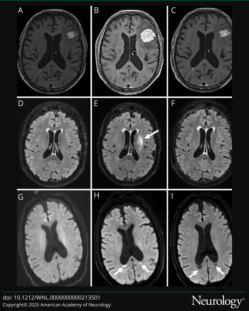 Neurotoxicity in Patients With CNS Lymphomas Treated With CAR T-Cell Therapy: A Study From the French Oculo-Cerebral Lymphoma Network
hubs.la/Q03h2M1-0