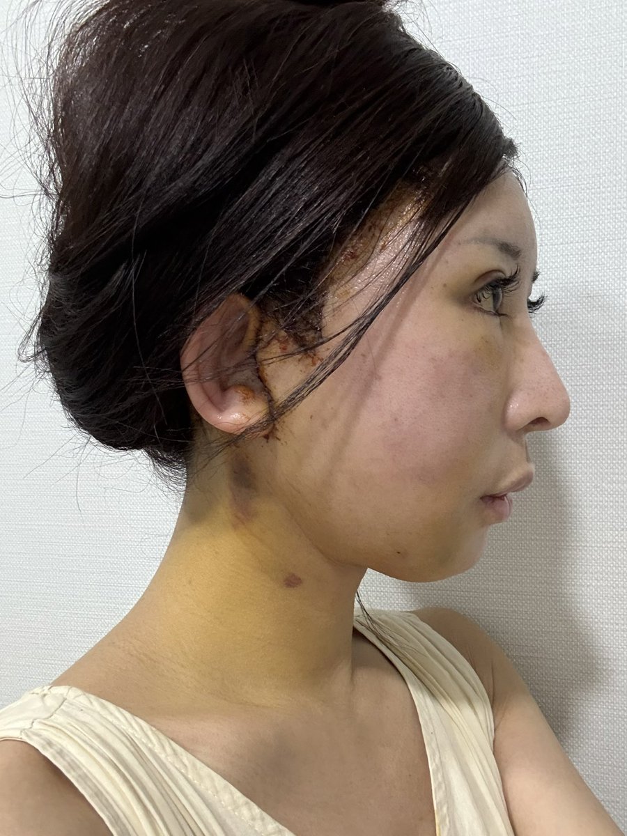 an20230422's tweet photo. 【術後5日目】
腫れや痣がどんどん下にさがってきています！首が全体的に黄色なり濃い痣も下がってきて見えるようになりました。
フェイスラインは腫れでかなりもったりしてますが、少しずつスッキリしてきている感じです♪

#セミン整形外科 #整形垢 #韓���整形 
#切開リフト #フェイスリフト https://t.co/KazHjxjNYq