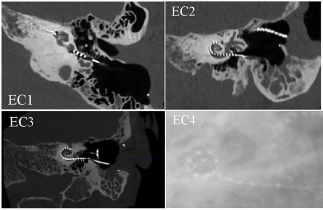 Mayo Clinic ENT (@mayoclinicent) on Twitter photo Can electrical field imaging (EFI) reliably detect extracochlear electrodes in cochlear implants by analyzing impedance patterns?
Click to read more: bit.ly/3G3g6H1
#MayoClinicENTResearch #MedTwitter <a href="/SaojiAniket/">Aniket Saoji</a> <a href="/KellyStaricha/">Kelly Staricha</a> #MelissaDeJong #JamesDornhoffer Can electrical field imaging (EFI) reliably detect extracochlear electrodes in cochlear implants by analyzing impedance patterns?
Click to read more: bit.ly/3G3g6H1
#MayoClinicENTResearch #MedTwitter <a href="/SaojiAniket/">Aniket Saoji</a> <a href="/KellyStaricha/">Kelly Staricha</a> #MelissaDeJong #JamesDornhoffer