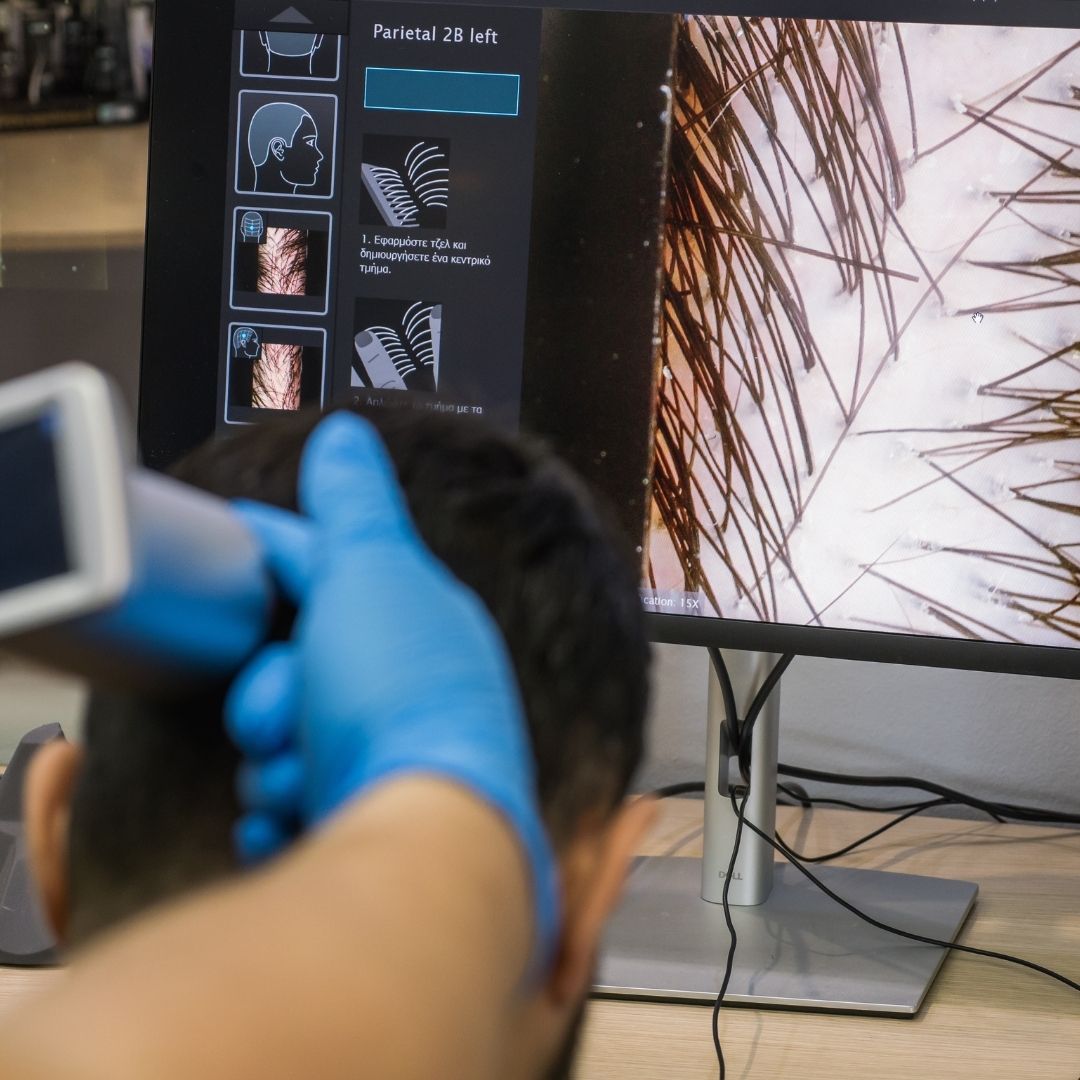 Dealing with hair loss? Discover everything about diagnosis and the solutions we offer! 🌟 Take the first step towards hair restoration with the help of our specialized medical team. 📲 Book your appointment today and find the best solution for you! 💆‍♂️✨
#dhi #diagnosis #hairloss