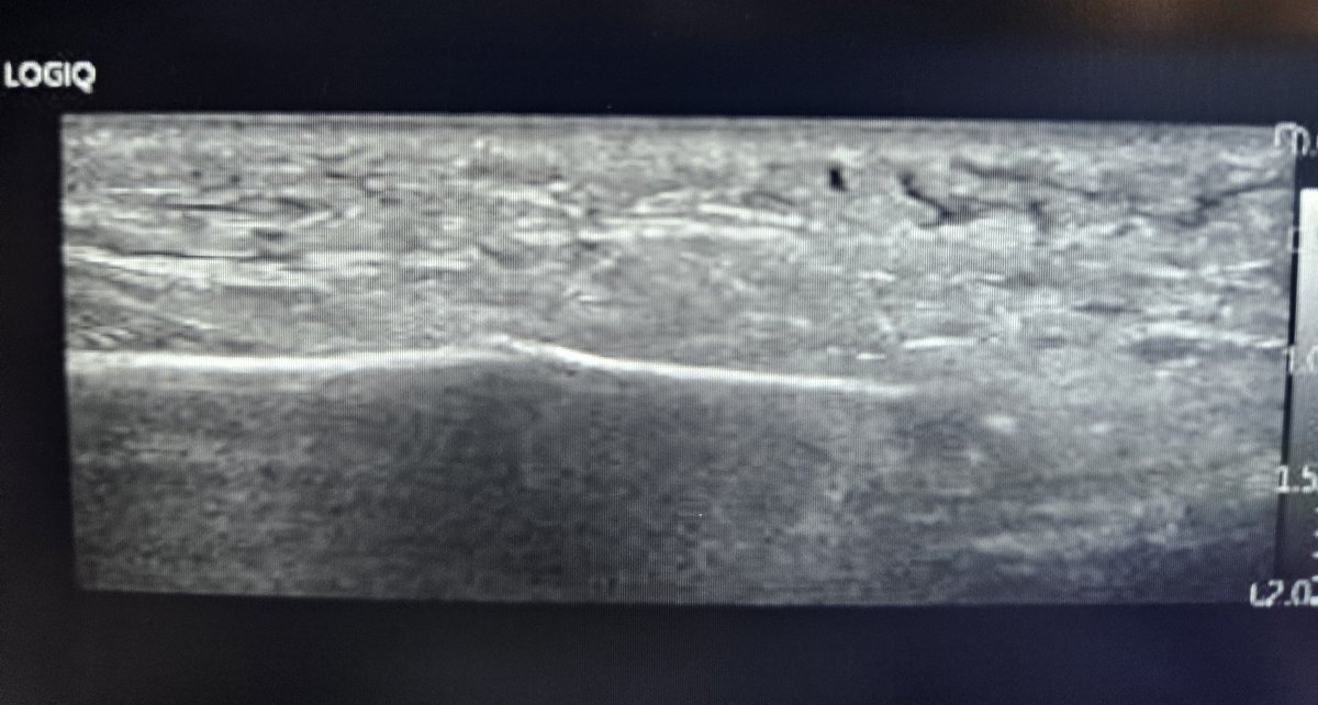Luisa Nieto (@luisaniemor) on Twitter photo Fracture bad seen on plain radiographs, due to lack of displacement. US successfully detected hematome and fracture.
<a href="/residentesSERAM/">Residentes SERAM</a> <a href="/MskSerme/">SERME</a> <a href="/SERAM_RX/">SERAM - Sociedad Española de Radiología Médica</a> Fracture bad seen on plain radiographs, due to lack of displacement. US successfully detected hematome and fracture.
<a href="/residentesSERAM/">Residentes SERAM</a> <a href="/MskSerme/">SERME</a> <a href="/SERAM_RX/">SERAM - Sociedad Española de Radiología Médica</a>