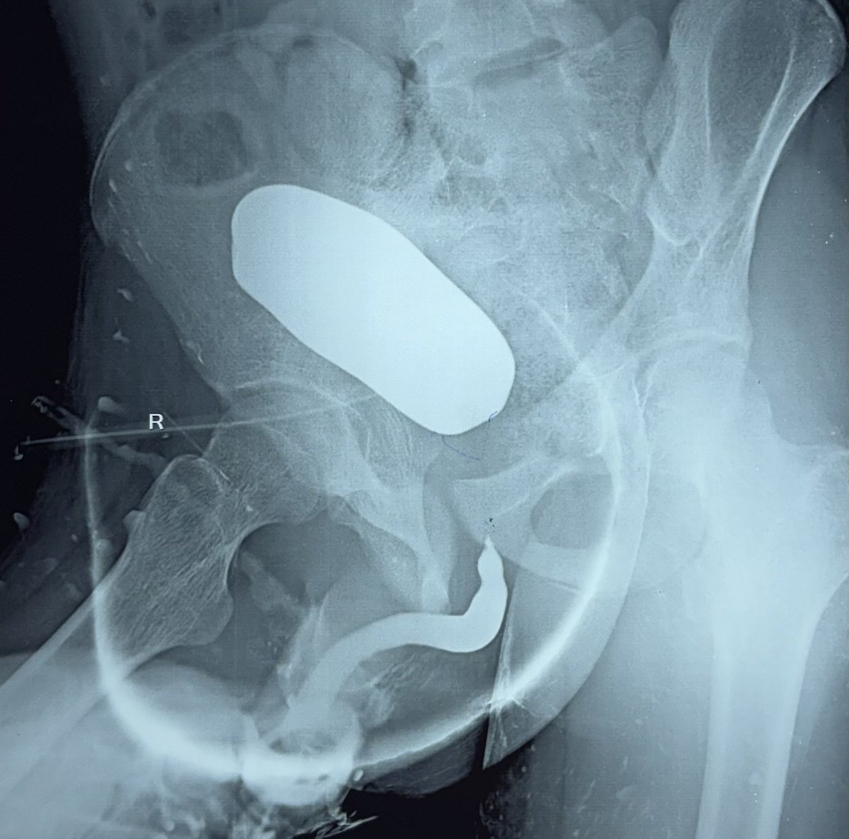 drjoshi_pankaj's tweet image. Pelvic fracture urethral injury
Closed bladder neck ? Bladder neck trauma
MRI with Joshi protocol
Full bladder with Saline
Lignocaine jelly in anterior urethra
T2 Saggital imaging
Excellent images @SocietyGURS @ISORU1
Turk J Urol. 2021 Jan;47(1):35-42