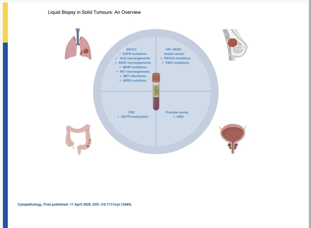 Pasquale Pisapia (@pasqualepisapia) on Twitter photo Proud to share our review entitled "liquid biopsy in solid tumours: an overview". onlinelibrary.wiley.com/doi/10.1111/cy… <a href="/CytopathologyJ/">Cytopathology</a> <a href="/UmbertoMalapel1/">Umberto Malapelle</a> <a href="/isliquidbiopsy/">International Society of Liquid Biopsy</a> <a href="/OncoAlert/">OncoAlert</a> Proud to share our review entitled "liquid biopsy in solid tumours: an overview". onlinelibrary.wiley.com/doi/10.1111/cy… <a href="/CytopathologyJ/">Cytopathology</a> <a href="/UmbertoMalapel1/">Umberto Malapelle</a> <a href="/isliquidbiopsy/">International Society of Liquid Biopsy</a> <a href="/OncoAlert/">OncoAlert</a>