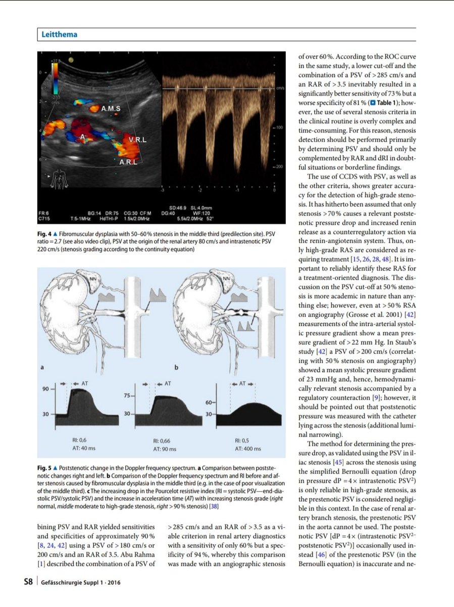 Joaquín Martínez (@jmmr83) on Twitter photo Ultrasonido en estenosis de arterias renales
<a href="/NephroP/">NephroPOCUS</a> <a href="/OswaldoRamosN/">Dr. Oswaldo Ramos</a> <a href="/javiteigell/">Javier Teigell</a> <a href="/y_interna/">Medicina Interna. Lo miro y mañana te digo.</a> <a href="/yaletung/">Yale Tung-Chen</a> <a href="/SonoSamMD/">Samuel García Rubio</a> <a href="/curromir/">Curro Miralles</a> <a href="/zbriote/">José António Briote Mariz</a> <a href="/PierpaDiNick/">Pierpaolo Di Nicolò</a> <a href="/ABCDEcografia/">ABCDEcografía</a> <a href="/jpalacinp/">Jose Maria Palacin</a> <a href="/jorgezzb/">Jorge Zegarra</a> <a href="/ignaciomsb/">Ignacio M Sánchez 🇪🇦🇪🇺🇺🇦🎸</a> <a href="/mberchid/">M. Solimán Berchíd Debdi</a> <a href="/AlvarezHigueras/">Fco. Javier Alvarez Higueras</a> <a href="/USPed_Latam/">USPed</a> <a href="/EcosemfyC/">EcosemFYC</a> <a href="/GTEcoSemergen/">Grupo Trabajo Ecografía Semergen #GTEcoSemergen</a> <a href="/GTECOSEMI/">GT Ecografía SEMI</a> Ultrasonido en estenosis de arterias renales
<a href="/NephroP/">NephroPOCUS</a> <a href="/OswaldoRamosN/">Dr. Oswaldo Ramos</a> <a href="/javiteigell/">Javier Teigell</a> <a href="/y_interna/">Medicina Interna. Lo miro y mañana te digo.</a> <a href="/yaletung/">Yale Tung-Chen</a> <a href="/SonoSamMD/">Samuel García Rubio</a> <a href="/curromir/">Curro Miralles</a> <a href="/zbriote/">José António Briote Mariz</a> <a href="/PierpaDiNick/">Pierpaolo Di Nicolò</a> <a href="/ABCDEcografia/">ABCDEcografía</a> <a href="/jpalacinp/">Jose Maria Palacin</a> <a href="/jorgezzb/">Jorge Zegarra</a> <a href="/ignaciomsb/">Ignacio M Sánchez 🇪🇦🇪🇺🇺🇦🎸</a> <a href="/mberchid/">M. Solimán Berchíd Debdi</a> <a href="/AlvarezHigueras/">Fco. Javier Alvarez Higueras</a> <a href="/USPed_Latam/">USPed</a> <a href="/EcosemfyC/">EcosemFYC</a> <a href="/GTEcoSemergen/">Grupo Trabajo Ecografía Semergen #GTEcoSemergen</a> <a href="/GTECOSEMI/">GT Ecografía SEMI</a>