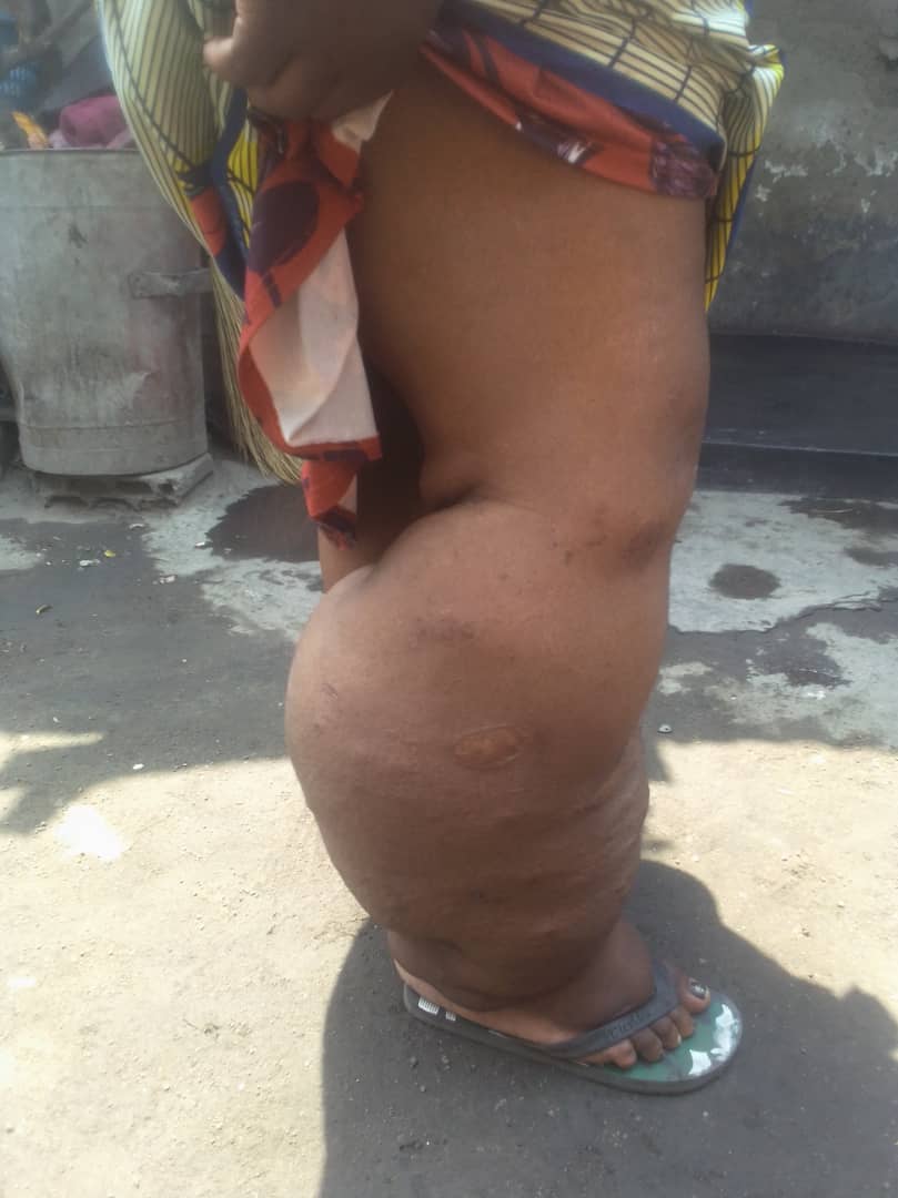 Elephantiasis, also known as lymphatic filariasis, is a neglected tropical disease that can cause severe swelling and disability. Despite the challenges, PCI HEALTH and other organizations are working to prevent, treat the disease and empower people living with NTDS.