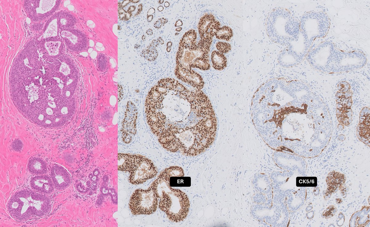 Atypical Ductal Hyperplasia (ADH) Low-grade cytology of FEA plus ...