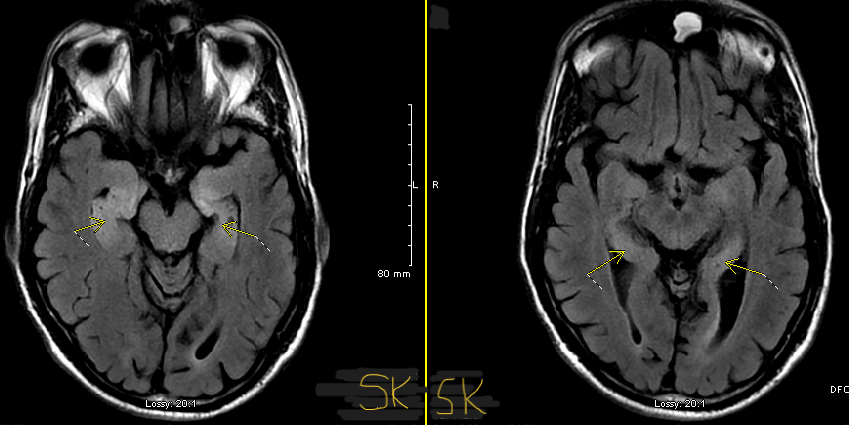 65-year-old man to his daughter-in-law: "You look very pretty today, let us go out for a movie."

➡️Mr Rakesh (name changed) presented with a 4-week history of psychiatric symptoms, including irritability, agitation, and inappropriate behavior directed toward his daughter-in-law.