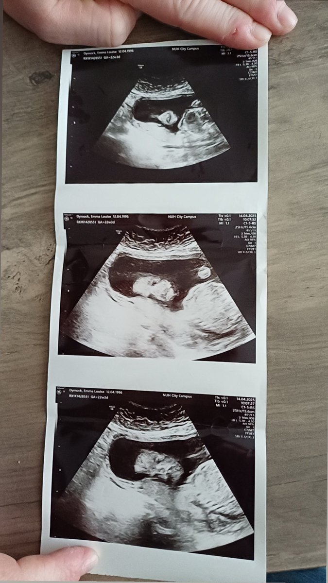 EmmaDymock6's tweet photo. 22 weeks 3 days getting regular scans as weight isn't where want to be but overall she's all good! https://t.co/4sNVEEj6Gq