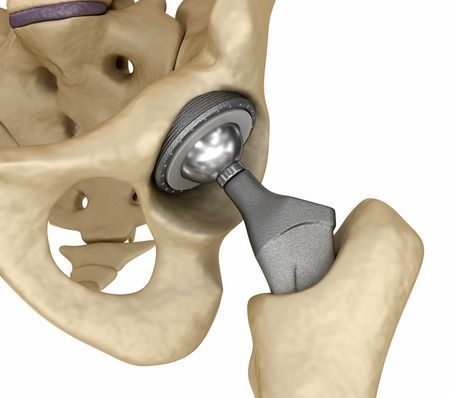 Metal joint implants may be leaking. Patients with replacements show higher cobalt levels in CSF, raising new safety questions. What does this mean for long-term management? buff.ly/jF5ggCO