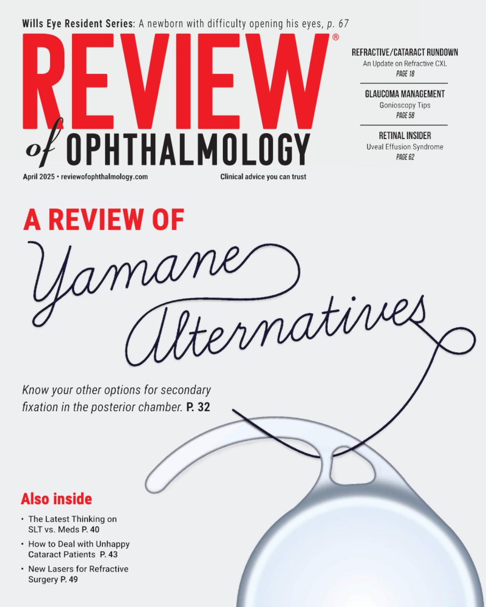 The April issue is now available! Find these four features inside:

👁Yamane Technique Alternatives
👁Glaucoma Treatment: SLT vs. Medical Therapy
👁Investigating IOL Complaints
👁The Next Gen. of Refractive Lasers

Read now at reviewofophthalmology.com 📖
#ophthalmology #cataract