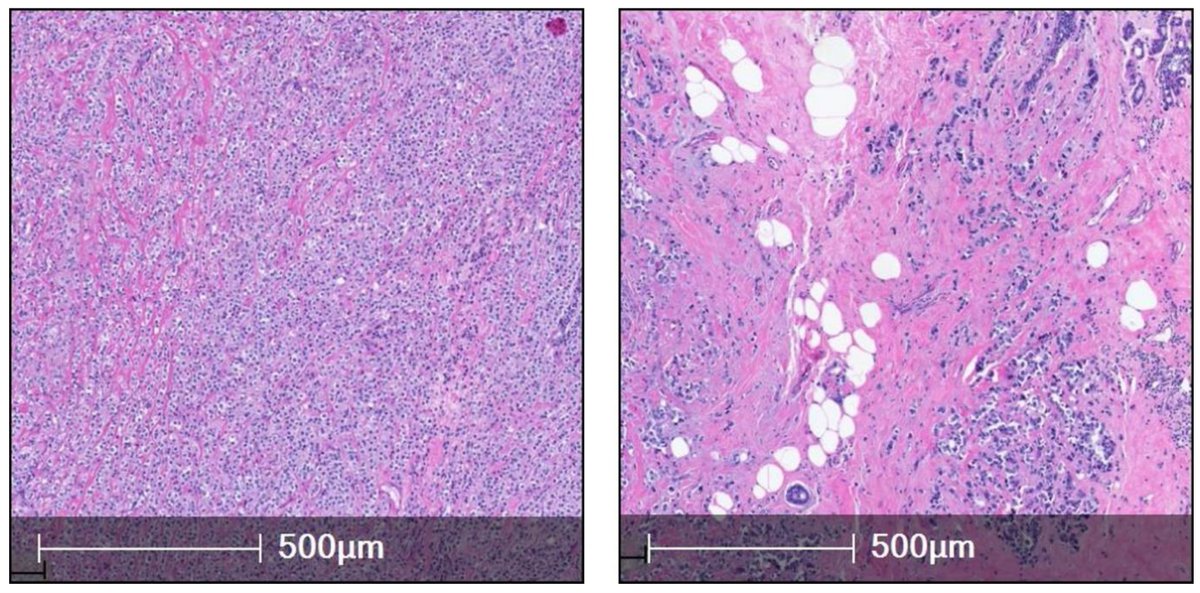 🧐Check out the #Review "Lobular Carcinoma of the Breast: A Comprehensive Review with Translational Insights"
👥by Harsh Batra <a href="/IndianPathbae/">Harsh Batra</a> et al. <a href="/MDAndersonNews/">MD Anderson Cancer Center</a>
📎Link here: mdpi.com/2072-6694/15/2…
Keywords: ILC; breast carcinoma; invasive lobular carcinoma