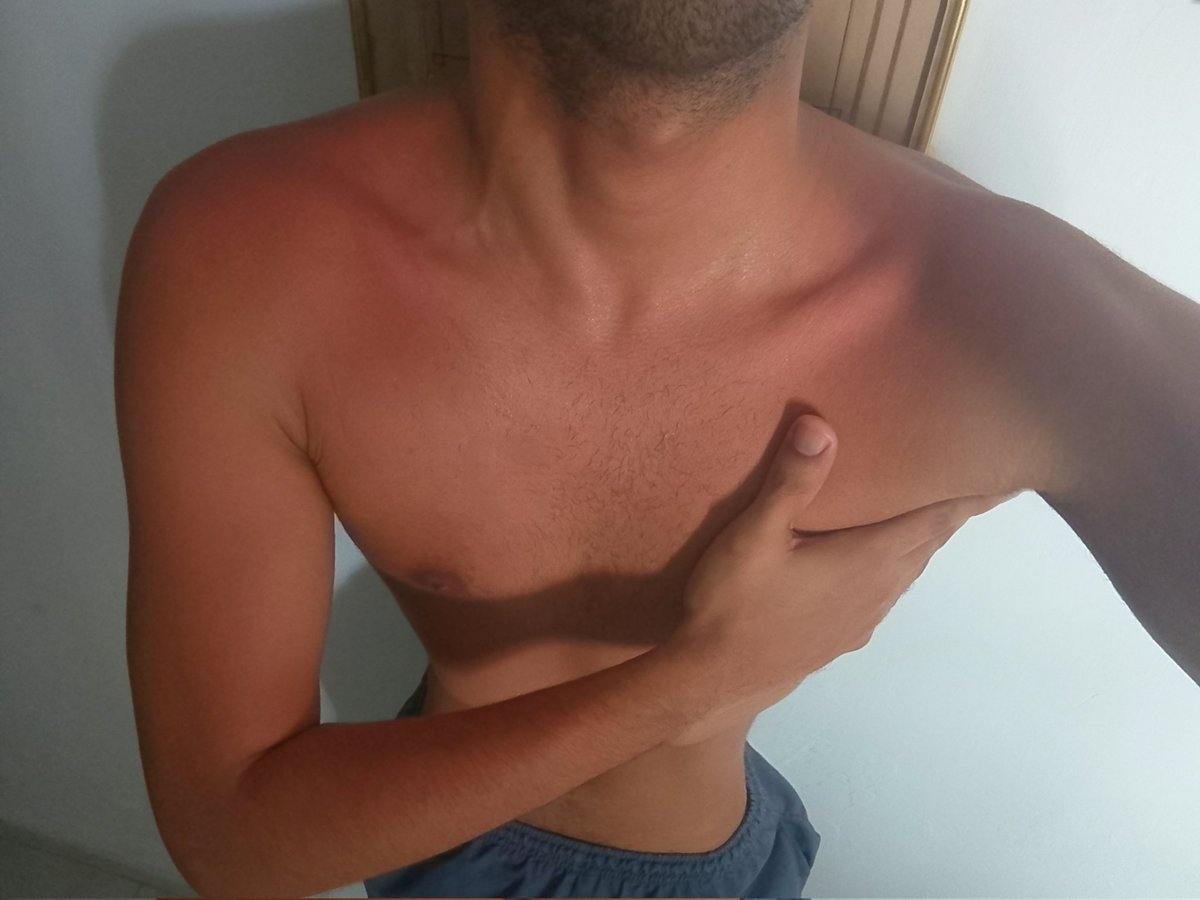 soyandres0206's tweet photo. Usen bloqueador también en el cuerpo, no sean como yo. https://t.co/3n3wt4U5VS