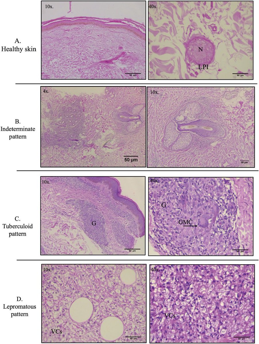 AJDP_Journal's tweet photo. #WhatsNewInDermpath
Evaluating advanced machine learning models for histopathological diagnosis of Hansen disease
- demonstrated an accuracy of 70%, sensitivity of 74%, and specificity of 65%.
- The ROC curve of showed an area under the curve of 0.71. https://t.co/iymQ2NpmXP