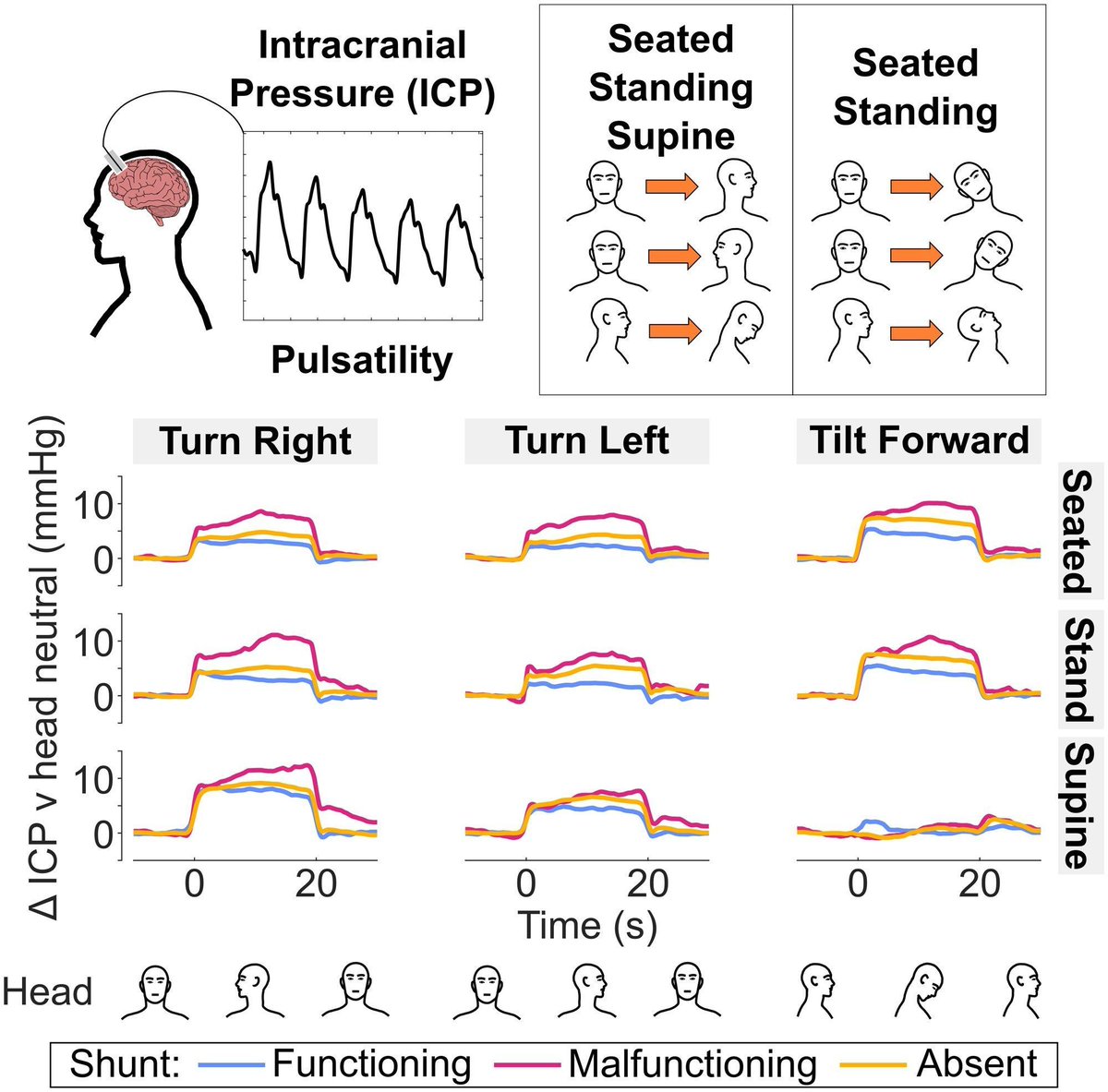 Bancroft et al. report head movements away from neutral increase intracranial pressure and pulsatility, effects varying by posture and shunt status. This may guide smart shunt design and symptom management. Read at buff.ly/XHhSnNC <a href="/battmancroft/">Matt Bancroft</a> <a href="/EleanorMoncur/">Eleanor Moncur</a> <a href="/AhmedToma13/">Ahmed Toma</a>