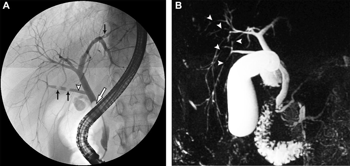 This review highlights key imaging patterns of autoimmune liver and biliary disorders at MRI/MRCP that are crucial in guiding diagnosis, directing further workup, monitoring disease progression and treatment response, and detecting complications. bit.ly/4lnO5Km