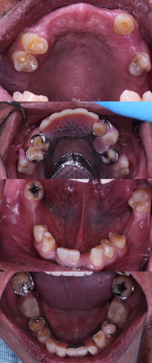 Saleh Y. AlYousef (@drbinyousef) on Twitter photo C.C
''I want new dentures and crowns, pointed #31 & #41''
RPD:
|Upper C I mod 2 -MC- AP palatal strap
|Lower C III mod 3 -MC- Lingual Plate
Difficulties:
|Compromised Occlusal Surfaces(OVD)
|Retention, Esthetic & Stability Issues
كل الشكر والتقدير للأستاذ <a href="/hass2009an/">Hassan Aldawsari</a> على جهوده. C.C
''I want new dentures and crowns, pointed #31 & #41''
RPD:
|Upper C I mod 2 -MC- AP palatal strap
|Lower C III mod 3 -MC- Lingual Plate
Difficulties:
|Compromised Occlusal Surfaces(OVD)
|Retention, Esthetic & Stability Issues
كل الشكر والتقدير للأستاذ <a href="/hass2009an/">Hassan Aldawsari</a> على جهوده.