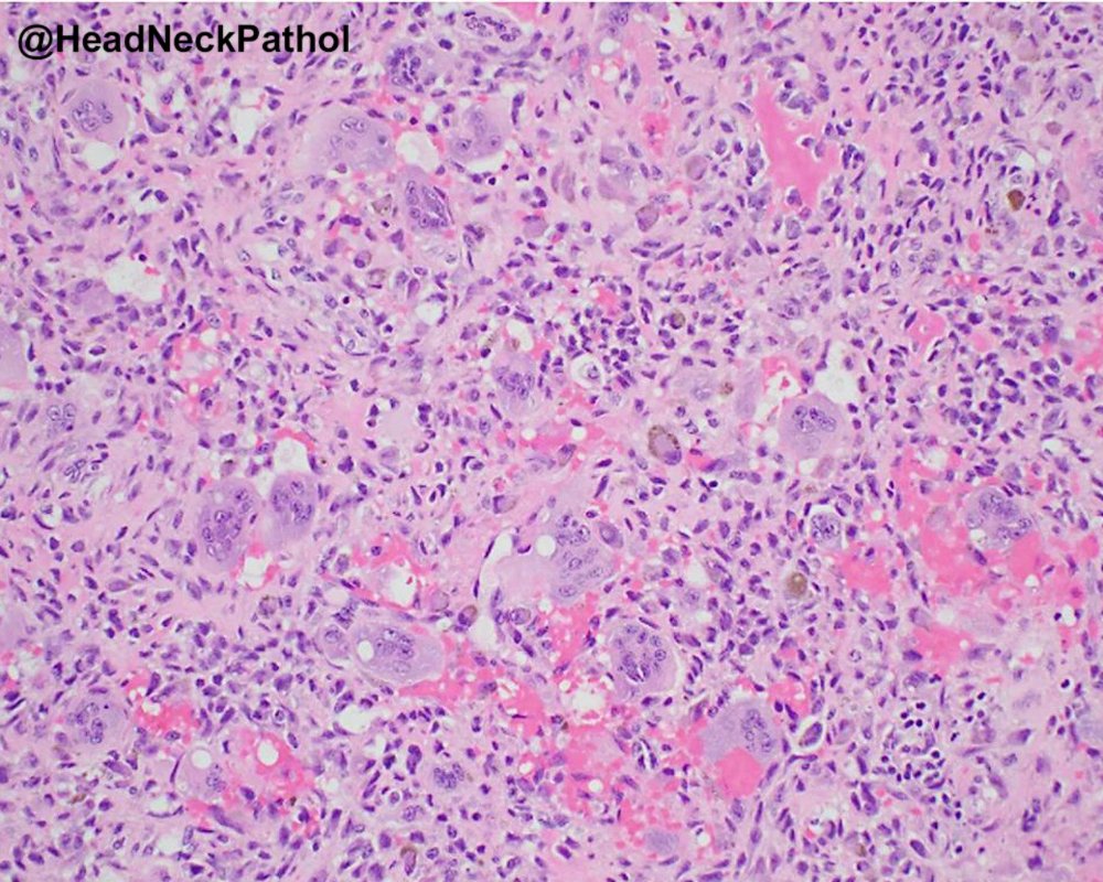 HeadandNeckPath's tweet photo. Recurrent Diffuse Tenosynovial Giant Cell Tumor of the Temporomandibular Joint
By Leen AlQudah, Elisa Hannan, Timothy Turvey, Carlos David &amp; Laleh Hakima
https://t.co/Eo6bd5MSyU
#HeadNeckPathol #HNPJ #HeadandNeckPath #Pathology #ENTPath #PathologyTweet https://t.co/yP6c1bAdVl