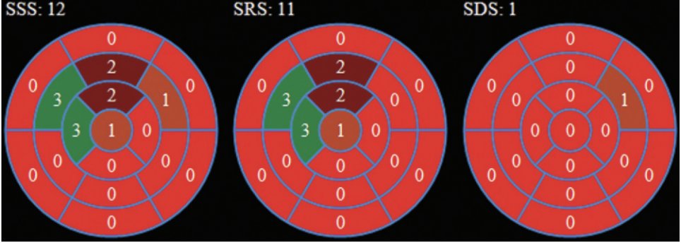 🧠 #CardioNuggets: 

Summed Stress Score (SSS) in Nuclear Perfusion Imaging

🫀 17 LV segments scored 0–4 (0 = normal, 4 = no uptake)

➕ Total = SSS (max 68)

🔍 Interpretation:

0–3: Normal
4–8: Mild
9–13: Mod
≥14: Severe perfusion defect

📊 SSS = Scar + Ischemia

SDS =