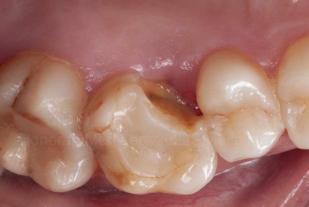 بعد معالجة عصب #الاسنان يكون السن معرض للكسر بشكل اسهل واسرع ، 

و العديد من المراجعين للأسف يتأخر في اكمال العلاج بعد زوال الألم وبالتالي يرجعون بكسر في السن يستدعي خلعه واستبداله بزرعه.

لذلك مهم جداً من المبادرة بوضع التلبيسة المناسبة وعدم تأخيرها بعد معالجة العصب