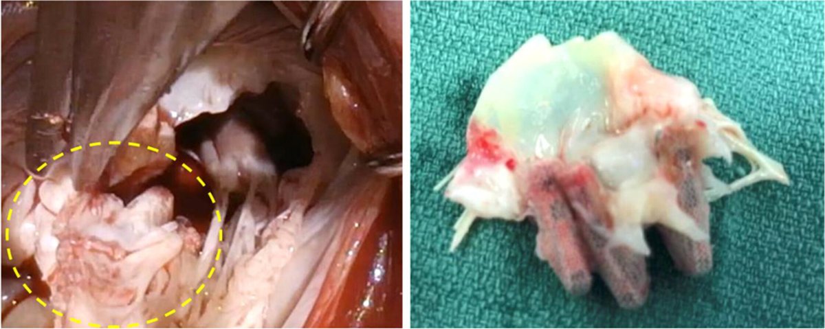 Dr. Gilbert Tang (@gilberttangmd) on Twitter photo Congrats <a href="/MMarinCuartas/">Mateo MarĆn-Cuartas</a> <a href="/SyedZaidMD/">Syed Zaid, MD</a> et al for the CUTTING-EDGE failed M-TEER registry MV repair vs replacement JUST OUT <a href="/JACCJournals/">JACC Journals</a> #JACCINT! Most MV gets replaced with worse outcomes. Will see how REPAIR-MR and PRIMARY trial play out down the road!
jacc.org/doi/full/10.10⦠Congrats <a href="/MMarinCuartas/">Mateo MarĆn-Cuartas</a> <a href="/SyedZaidMD/">Syed Zaid, MD</a> et al for the CUTTING-EDGE failed M-TEER registry MV repair vs replacement JUST OUT <a href="/JACCJournals/">JACC Journals</a> #JACCINT! Most MV gets replaced with worse outcomes. Will see how REPAIR-MR and PRIMARY trial play out down the road!
jacc.org/doi/full/10.10ā¦