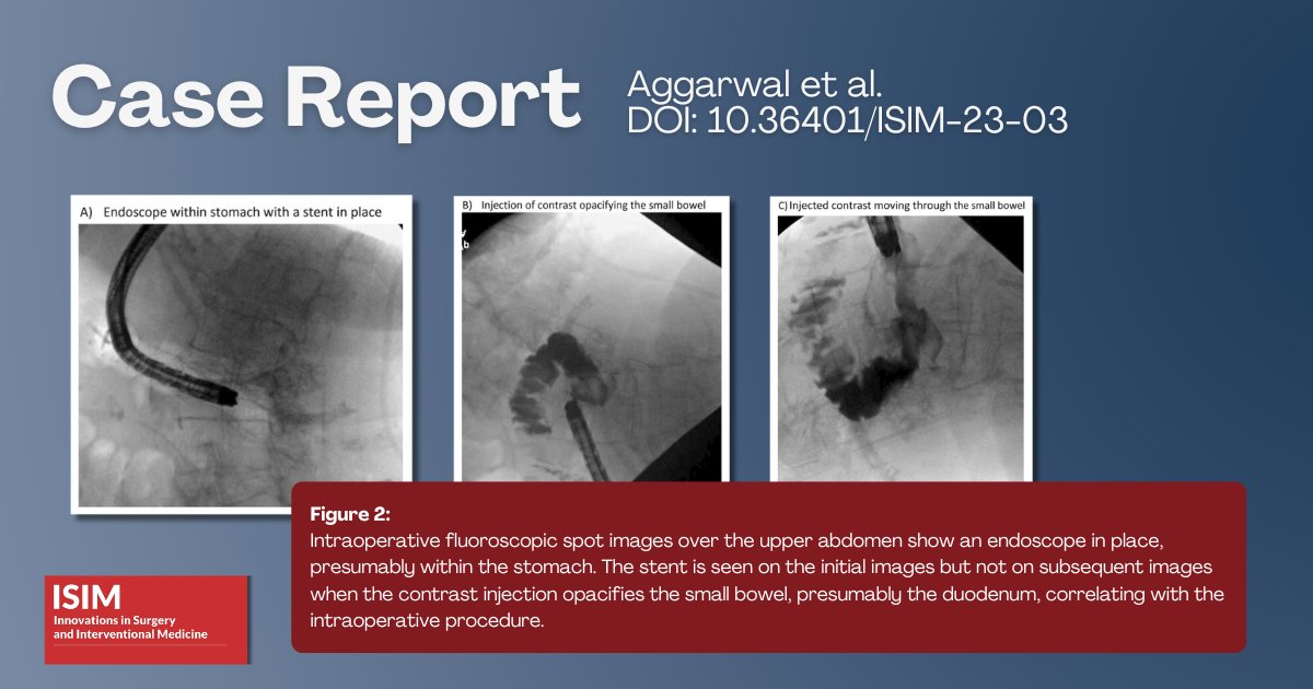 ISIM Editors (@editorsisim) on Twitter photo Aggarwal et al. explore a case study which emphasizes endoscopic stenting as an alternative to conventional surgical repair for iatrogenic #duodenalperforation
doi.org/10.36401/ISIM-…
#duodenalstent #endoscopy #ISIMJournal
<a href="/khaledalkattan/">خالد مناع القطان</a> <a href="/AzzamKhankan/">Azzam Khankan عزام خانكان</a> Aggarwal et al. explore a case study which emphasizes endoscopic stenting as an alternative to conventional surgical repair for iatrogenic #duodenalperforation
doi.org/10.36401/ISIM-…
#duodenalstent #endoscopy #ISIMJournal
<a href="/khaledalkattan/">خالد مناع القطان</a> <a href="/AzzamKhankan/">Azzam Khankan عزام خانكان</a>